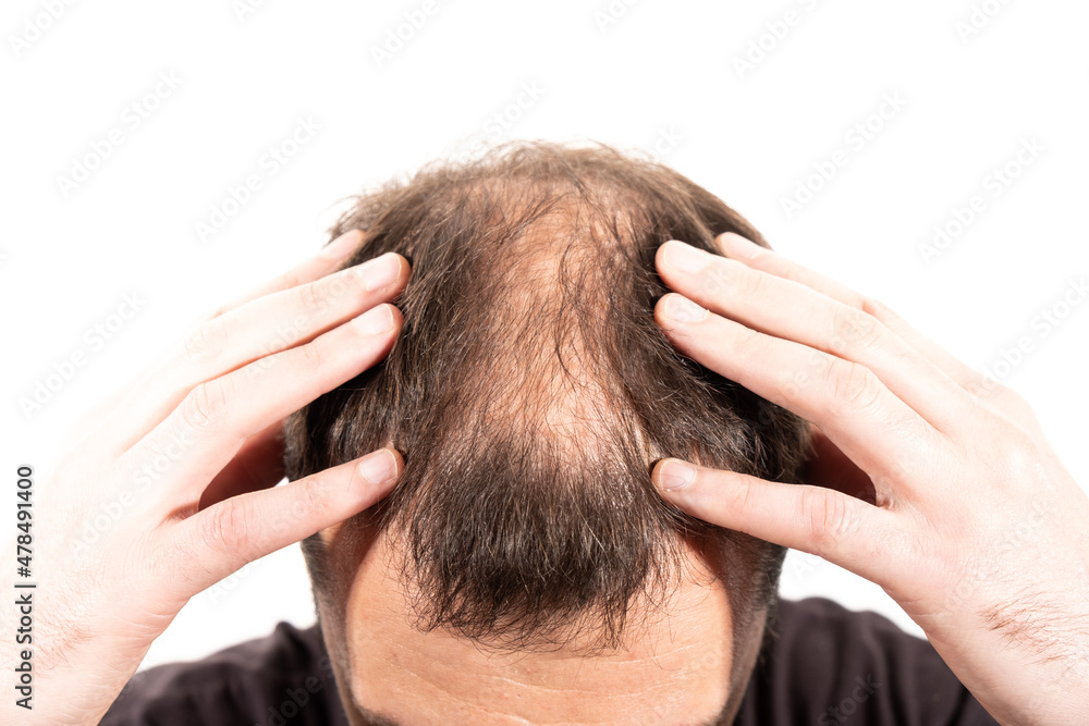Fototapeta premium Close-up balding head of a young man on a white isolated background.