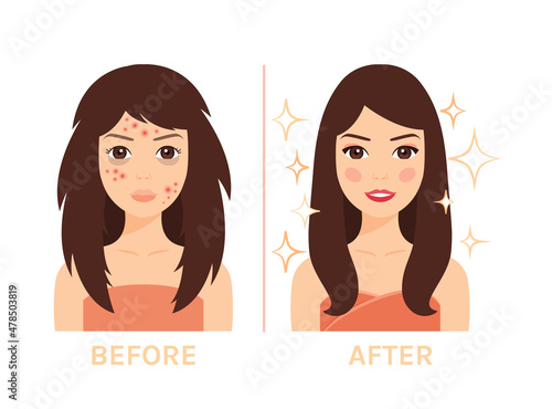 Beautiful Brunette Woman with Pimples and Dark Circles Under Eyes on Face. Fashionable Transformation. Pretty Happy Girl with Makeup and Red Lips. Cartoon style. White background. Vector illustration.