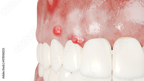 Tableau sur toile 3d rendered illustration of a dental abcess