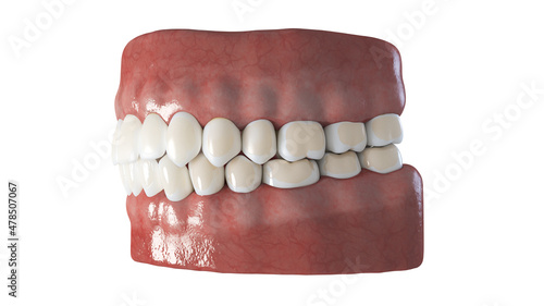 3d rendered illustration of dental demineralization photo