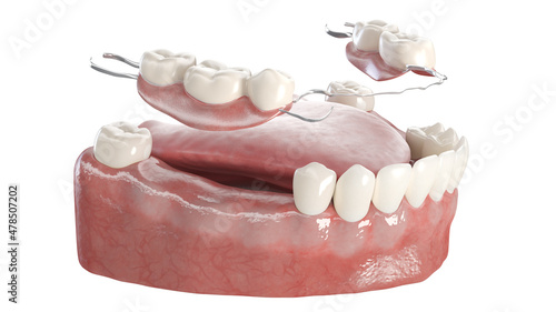 3d rendered illustration of a denture photo