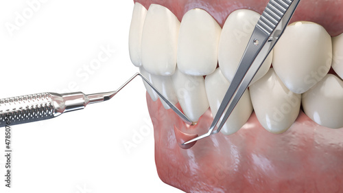 Canvas-taulu 3d rendered illustration of a gum graft surgery