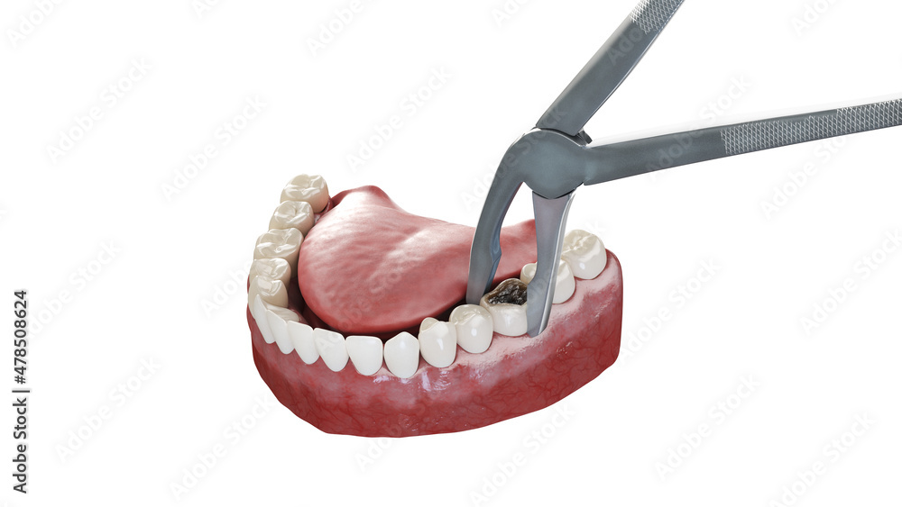 3d rendered illustration of a tooth extraction 3d rendered illustration of a tooth extraction