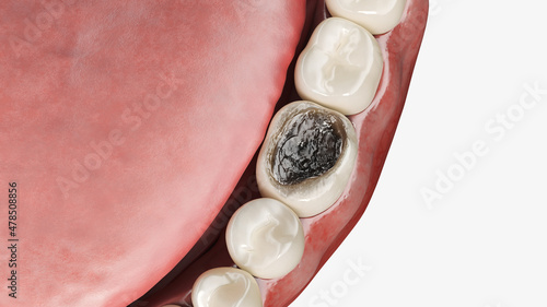 3d rendered illustration of tooth decay