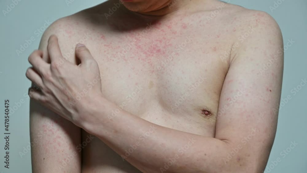 Dermatitis viral disease of young adult asian body standing scratching ...