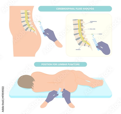 Lumbar puncture for infalmmation Bleeding cancer brain inject anaesthetic diagnosis disease disorder anaesthesia viral encephalitis syphilis