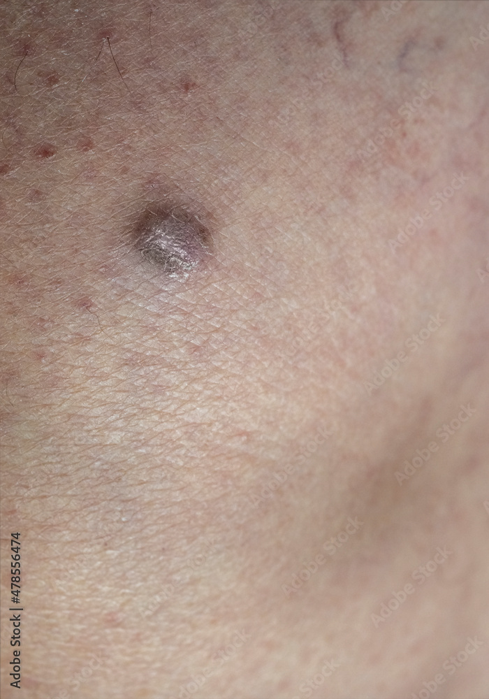 Close-up view of the an human skin with human skin sarcoma. Large suspicious dangerous mole on the skin Close-up view of the an human skin with human skin sarcoma. Large suspicious dangerous mole on the skin