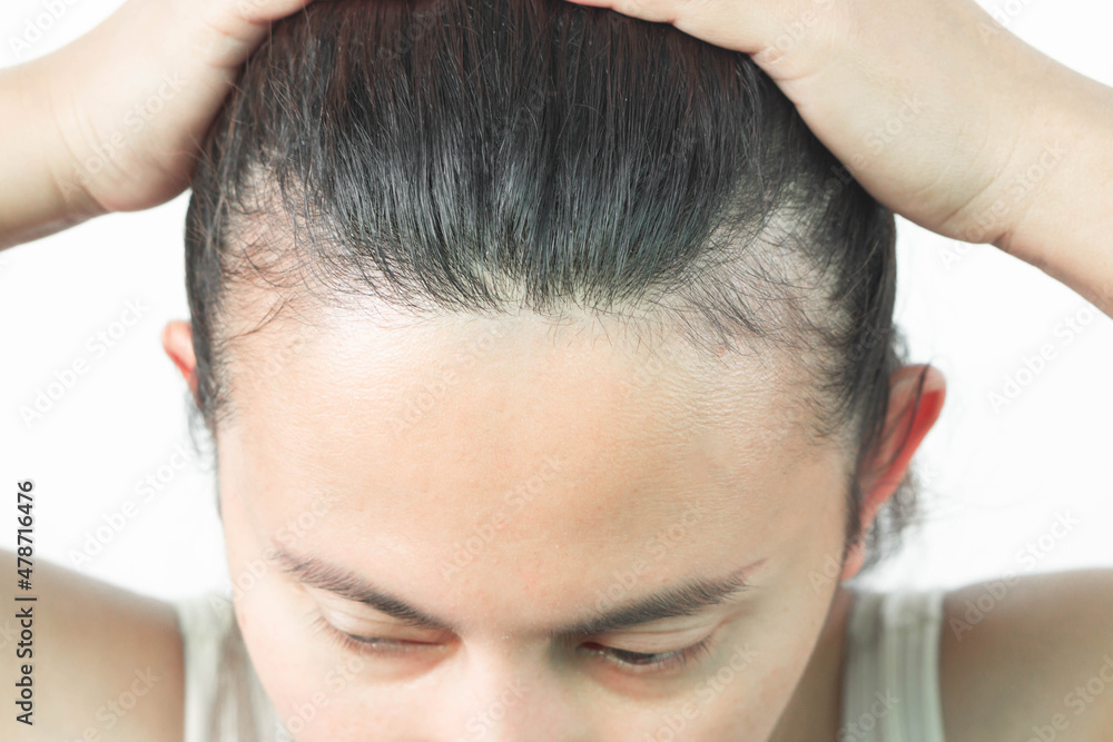 Woman serious hair loss problem for health care shampoo and beauty product concept, selective focus Woman serious hair loss problem for health care shampoo and beauty product concept, selective focus