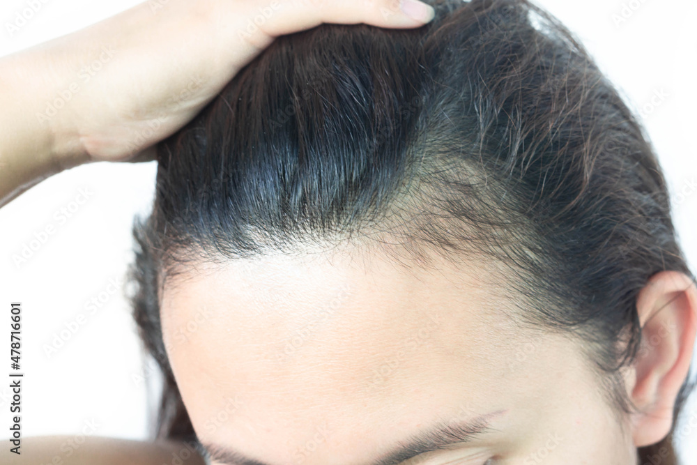 Woman serious hair loss problem for health care shampoo and beauty product concept, selective focus Woman serious hair loss problem for health care shampoo and beauty product concept, selective focus
