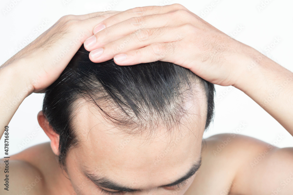 Fototapeta premium Closeup Young man serious hair loss problem with white backgroun for health care medical and shampoo product concept, selective focus