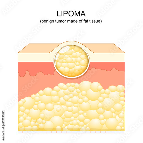Lipoma. adipose tumors. Skin layers