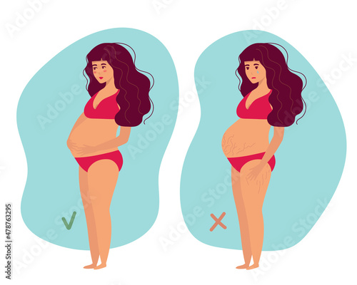 Pregnancy belly, stretch marks. Self love, body positive Motherhood. Preparation for childbirth. Vector illustration. For advertising, medical publications, for medicinal products, creams