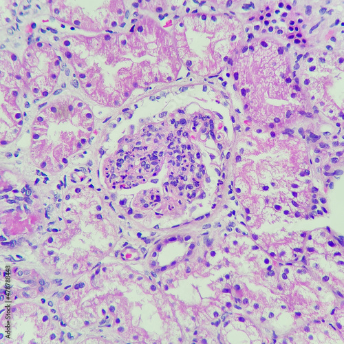 Camera photo of post infectious glomerulonephritis, showing several neutrophil infiltration in the glomeruli, magnification 400x, photograph through a microscope
