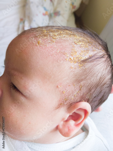 Newborn baby with symptoms of cradle cap (dermatitis seborrhoicum neonatorum) on the scalp.
