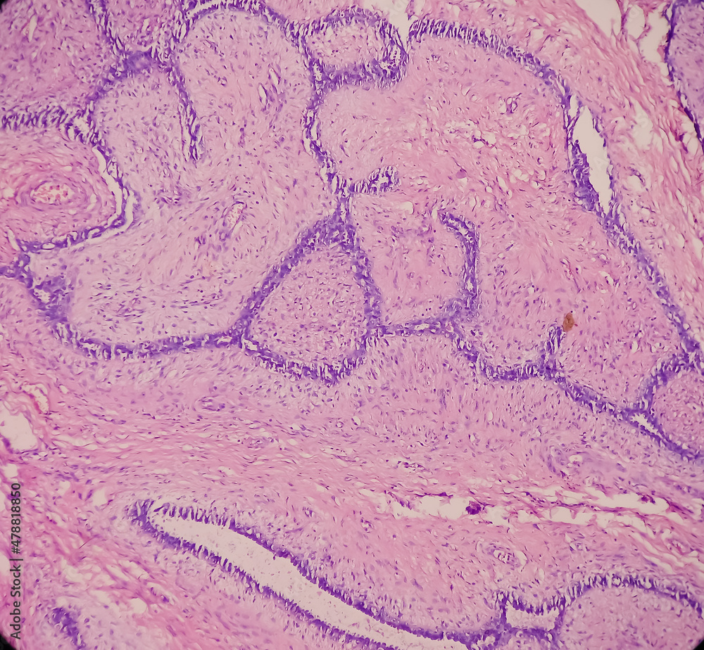 Breast Biopsy Microscopic image of a fibroadenoma, show benign neoplasm composed of delicate