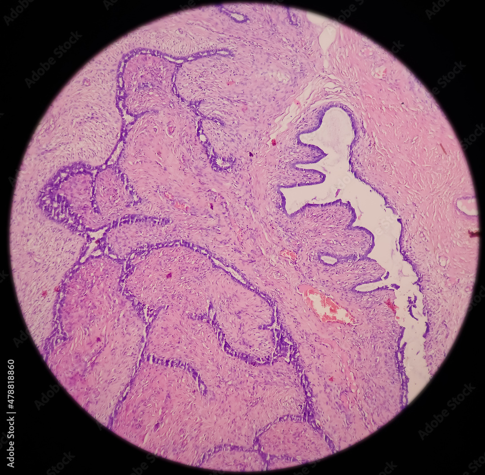 Breast Biopsy Microscopic image of a fibroadenoma, show benign neoplasm composed of delicate