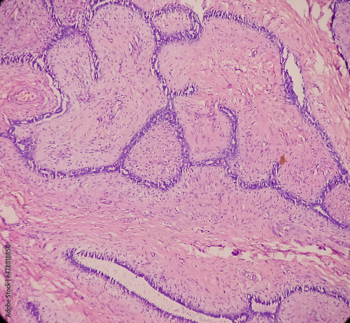 Breast Biopsy: Microscopic image of a fibroadenoma, show benign neoplasm composed of delicate proliferation of fibro muscular and glandular tissue on a myxoid background, benign tumor. photo