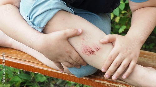 Closeup of injured young kid's knee after he fell down on pavement. the boy's leg hurts. bruise, scratch after summer walks or sports. anesthetic ointment