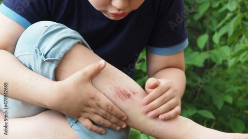 Closeup of injured young kid's knee after he fell down on pavement. the boy's leg hurts. bruise, scratch after summer walks or sports. anesthetic ointment photo