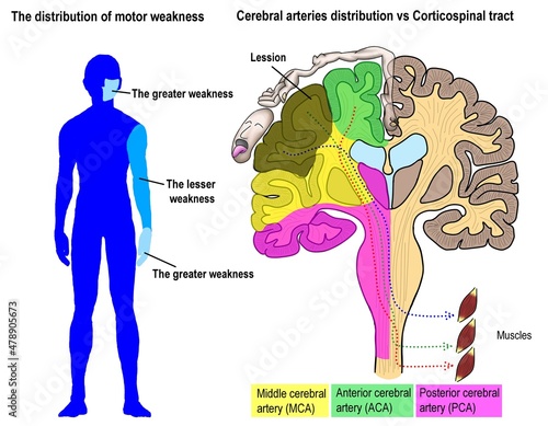 the pattern of muscle weakness regarding to the different location of ischemic stroke. photo