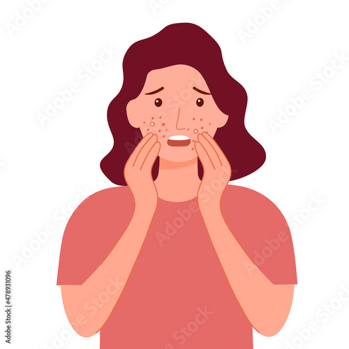 Young woman worrying about her acne on face in flat design. Pimple problem on female skin.
