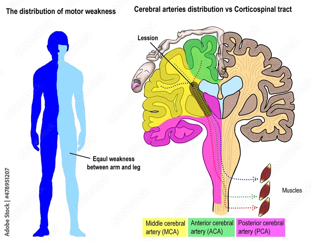 The different pattern of motor weakness according to the different