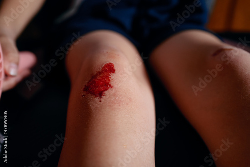 broke knee and bleeds