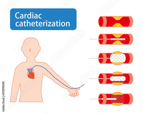 心臓カテーテル治療のイメージ