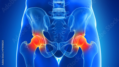 3d rendered illustration of painful hip joints