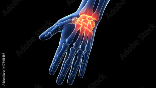 3d rendered illustration of a painful wrist