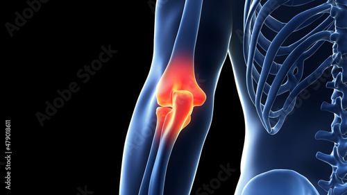 Photography 3d rendered illustration of a painful elbow joint