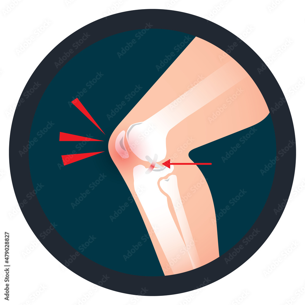 Orthopedics knee icon an injury of ACL or (Anterior Cruciate Ligament ...