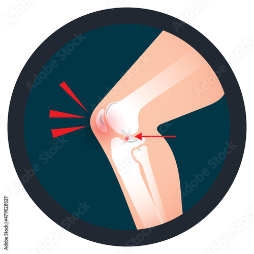 Orthopedics knee icon an injury of ACL or (Anterior Cruciate Ligament.