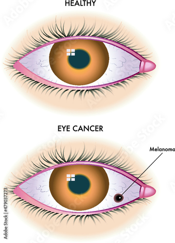 Medical illustration shows a healthy eye compared to one affected by melanoma.