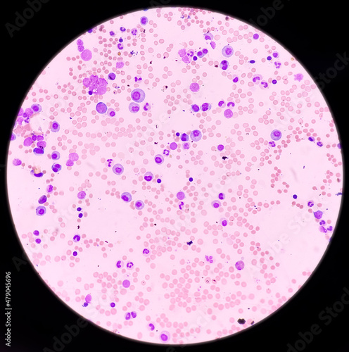 Microscopic view of bone marrow slide, megaloblastic anemia, mylodysplastic anemia, hyperactive and show normoblastic, early megaloblastic maturation, MDS disease photo