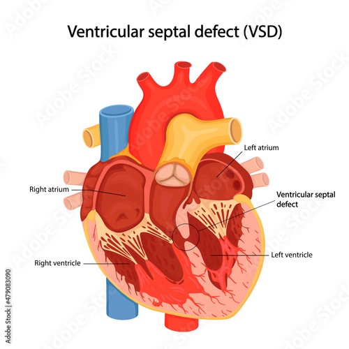 Ventricular septal defect (VSD). Congenital heart defect. cartoon anatomical illustration photo