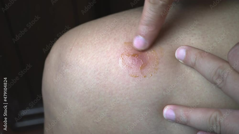 Vídeo do Stock: Footage b roll of Man with leg abscess Massage to ...