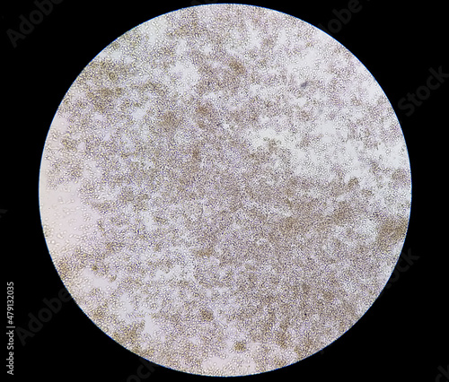 Microscopic image show plenty Pus cells. Urinary tract infection. Pyuria. photo