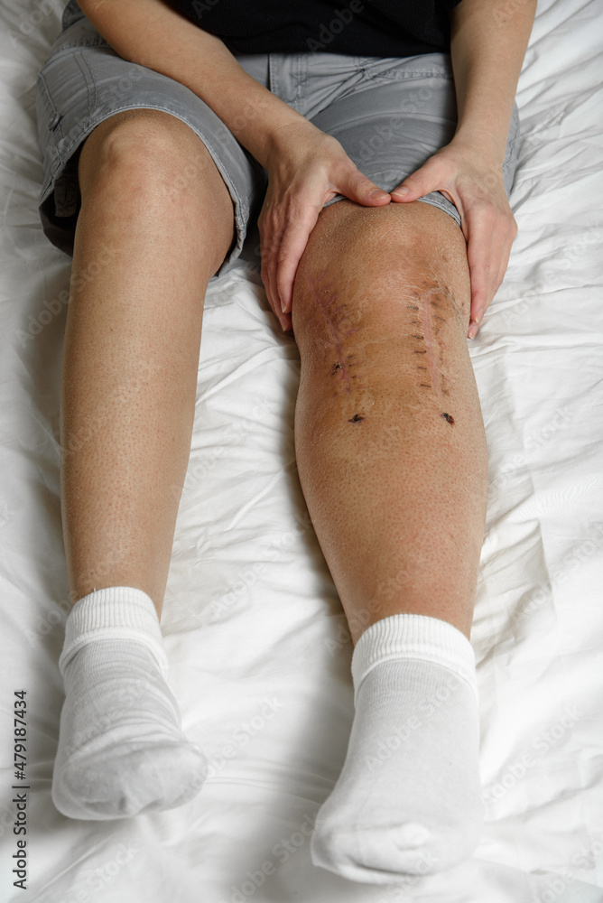 Woman patient holding her leg massaging postoperative suture. Knee fracture. Concept of rehabilitation and recovery after surgery on broken knee. Closeup.