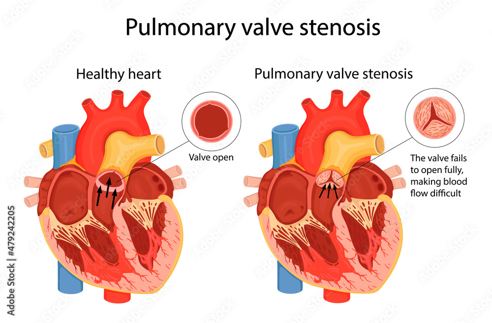 pulmonary valve stenosis. anatomical illustration - obrazy, fototapety, plakaty 