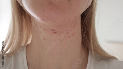 Woman with inflamed cystic acne on her neck and jawline area, close up.