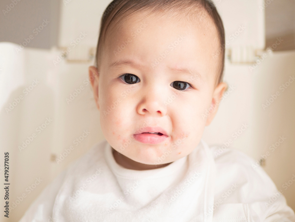 ハーフの赤ちゃんの口元の湿疹　イメージ　