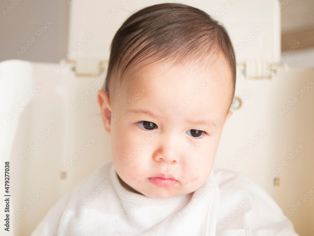 ハーフの赤ちゃんの口元の湿疹　イメージ　