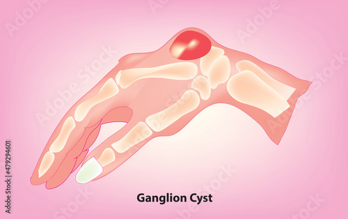 Biological illustration of ganglion cyst on wrist, fluid-filled swelling that usually develops, joint or tendon cyst