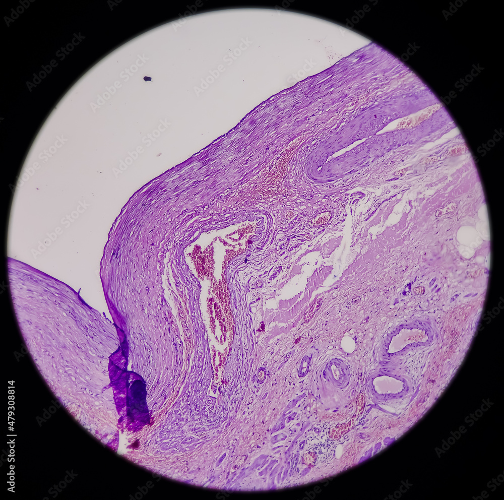 Tissue from endometrial polyp: Ovarian polyp, show myomatous polyp ...