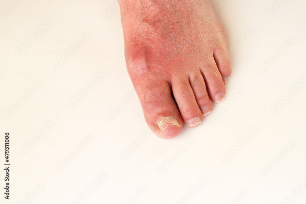 Fototapeta premium Swollen leg of a man with painful inflammation of gout. Fungus of the nail. There is free space for text.