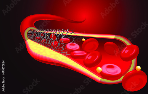 Medical and educational illustrations of the stent are already inserted, improving blood flow.