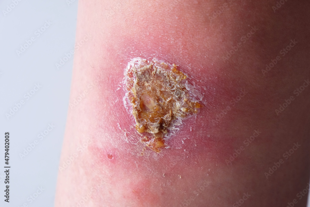 Close-up of an infected wound on  knee of  womans leg - obrazy, fototapety, plakaty 