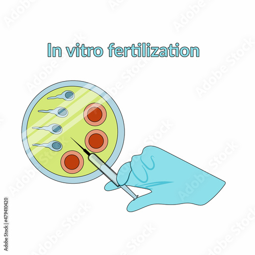 In vitro fertilization. Detailed infographic showing laboratory fertilization of eggs.
