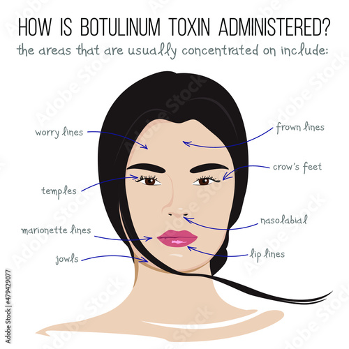 Vector illustration. How is botulinum toxin administered.
